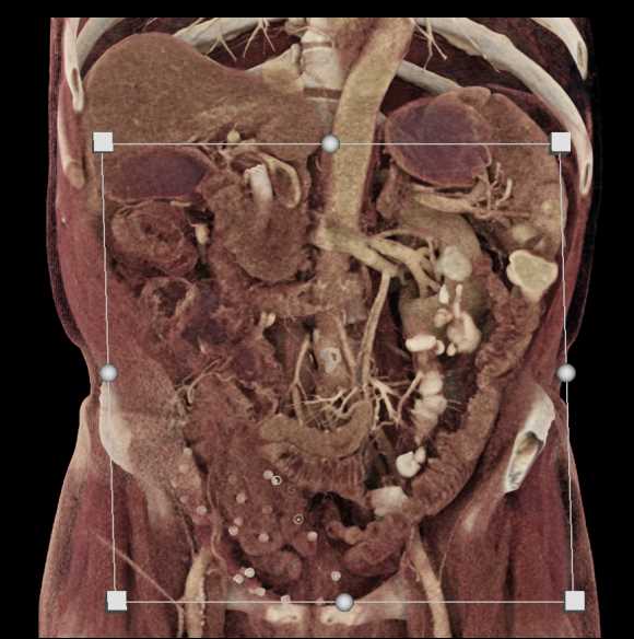 Carcinoma Head of Pancreas with Stent in Place - CTisus CT Scan