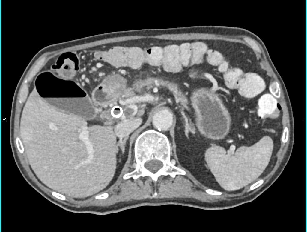 Carcinoma Head of Pancreas with Stent in Place - CTisus CT Scan