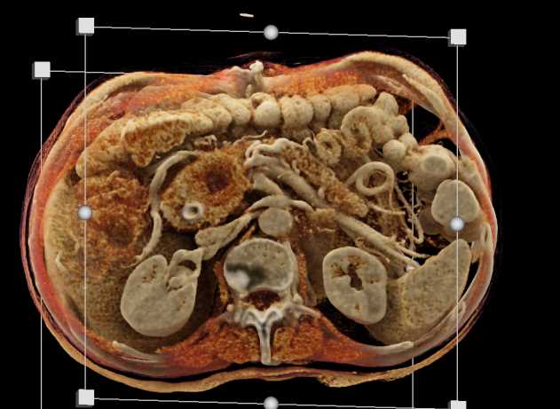 Carcinoma Head of Pancreas with Stent in Place - CTisus CT Scan