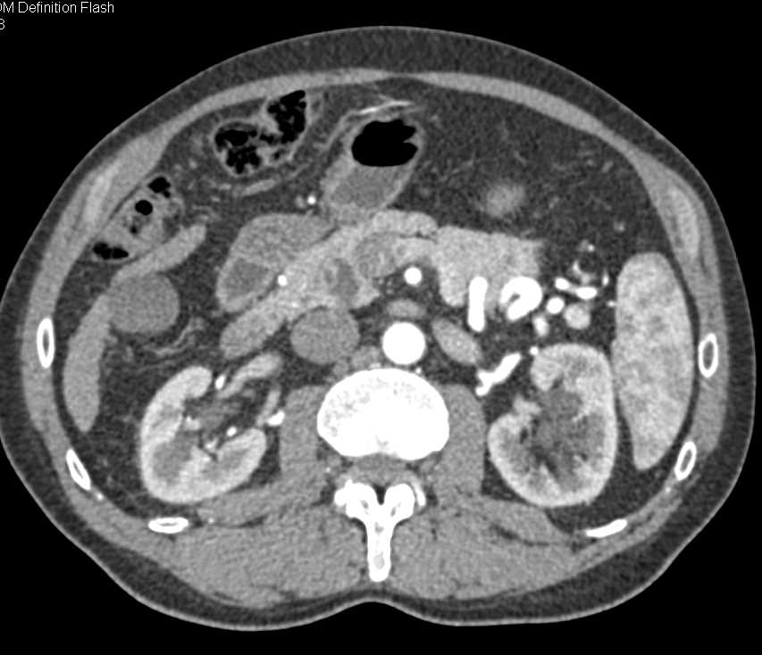 IPMN Head of Pancreas - CTisus CT Scan