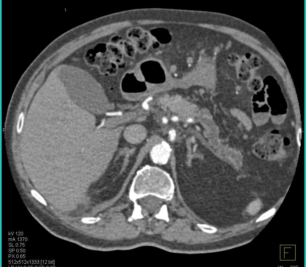 Main Duct IPMN - CTisus CT Scan