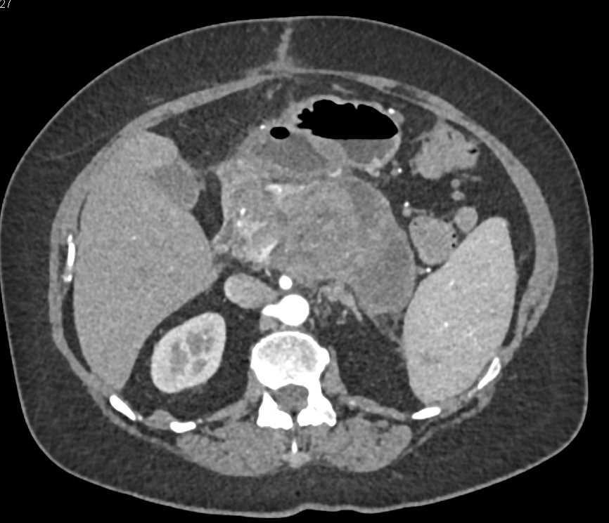 Serous Cystadenoma - CTisus CT Scan