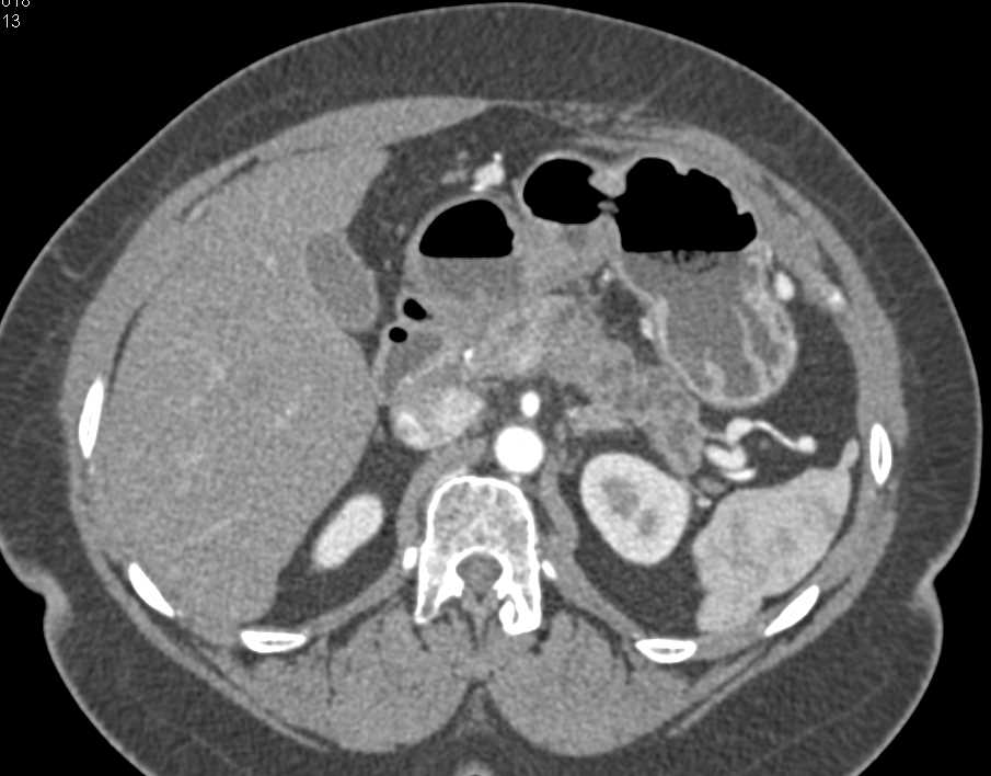 Invasive Pancreatic Cancer - CTisus CT Scan