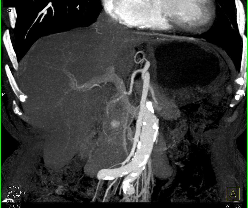 1cm PNET - CTisus CT Scan