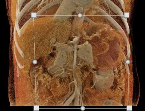 Pancreatic Cancer - CTisus CT Scan