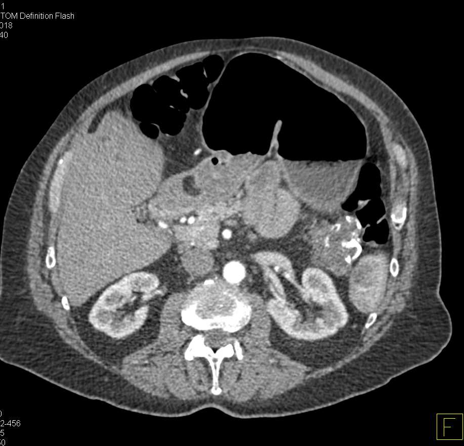 SPEN Tumor Tail of Pancreas - CTisus CT Scan