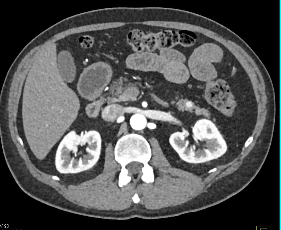 PNET Tail of Pancreas - CTisus CT Scan