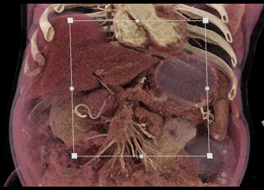 Adenocarcinoma Pancreas - CTisus CT Scan