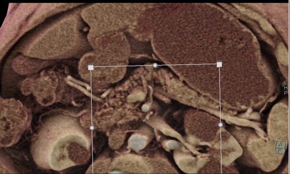 subtle Adenocarcinoma Pancreas - CTisus CT Scan