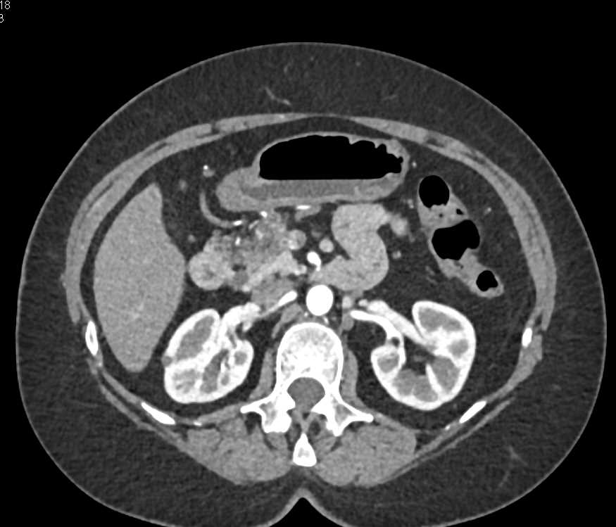 Acute Pancreatitis Simulates Mass - CTisus CT Scan