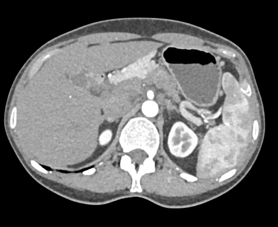 Adenocarcinoma Pancreas - CTisus CT Scan