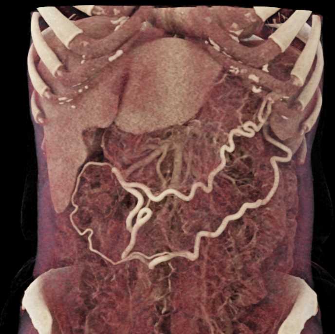 Adenocarcinoma Pancreas - CTisus CT Scan