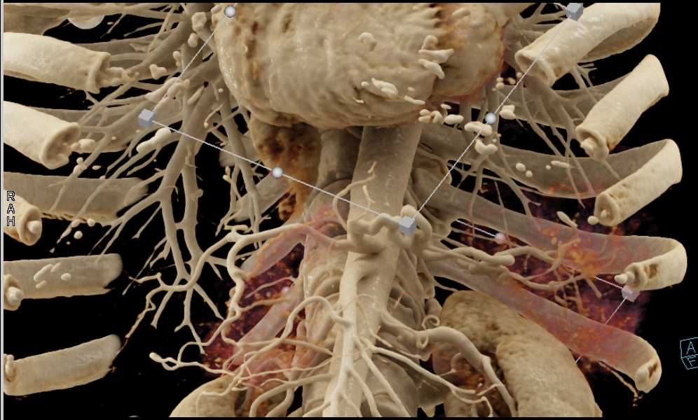 Adenocarcinoma Pancreas - CTisus CT Scan