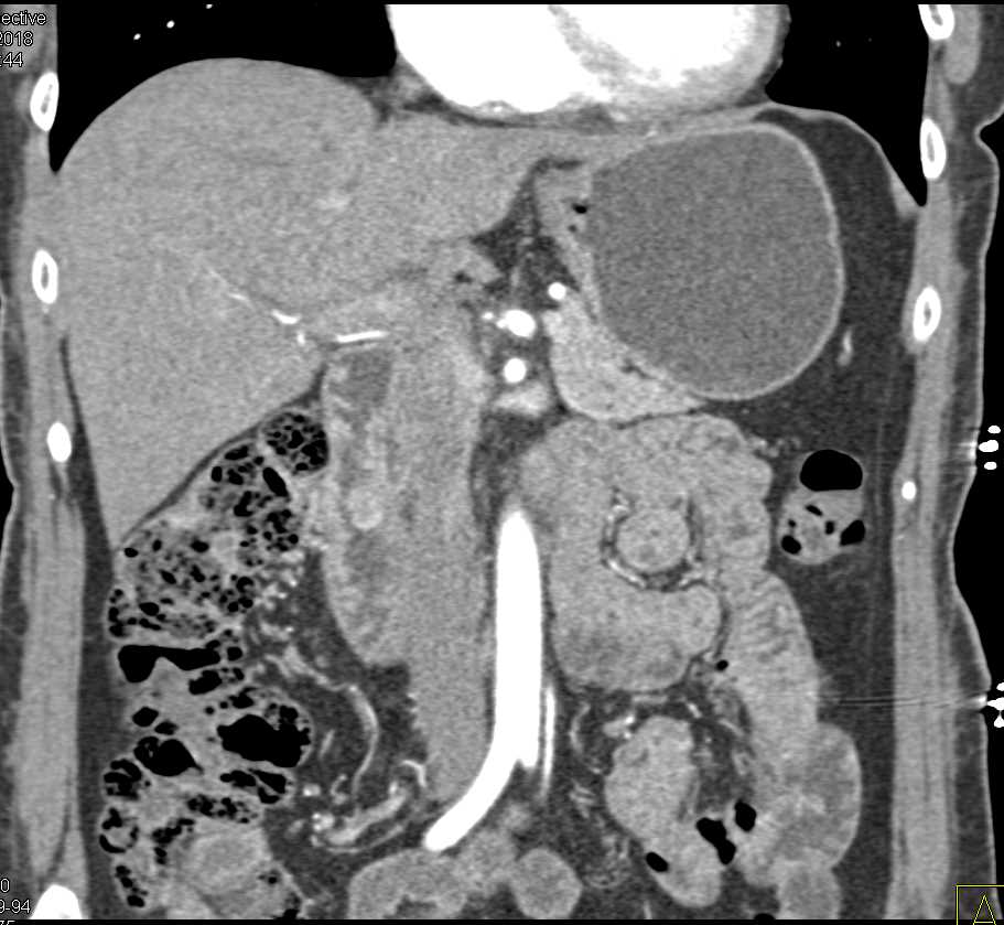 Ampullary Carcinoma - CTisus CT Scan