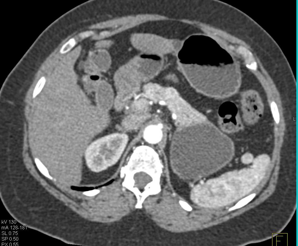 Pseudocyst Tail of Pancreas - CTisus CT Scan