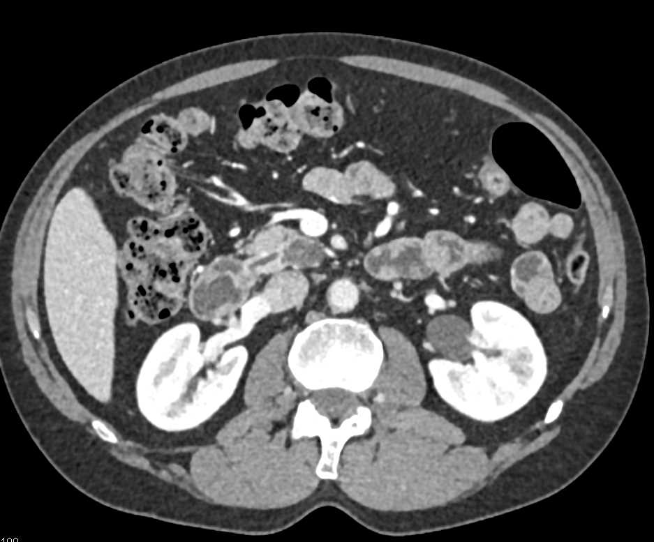 IPMN Head of Pancreas - CTisus CT Scan