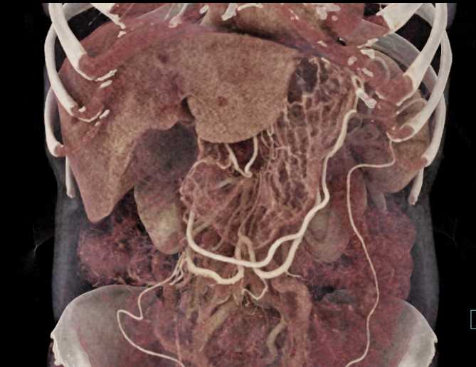 Invasive Pancreatic Adenocarcinoma - CTisus CT Scan