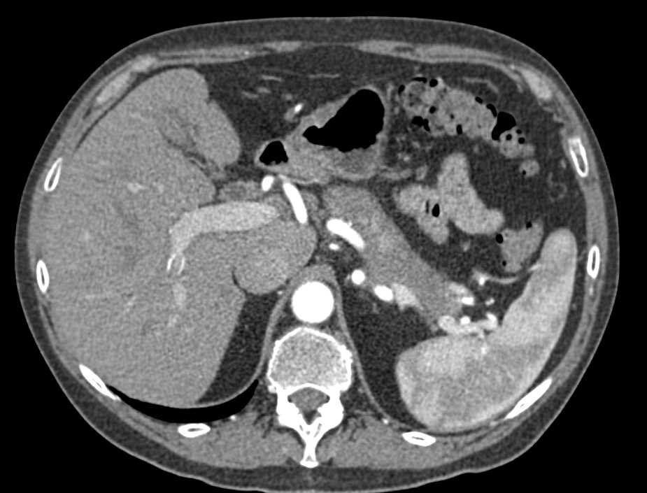 Pancreatic Adenocarcinoma Involves the CBD - CTisus CT Scan