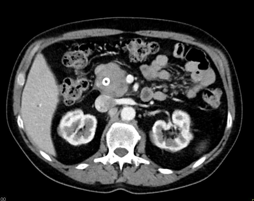 Pancreatic Adenocarcinoma - CTisus CT Scan