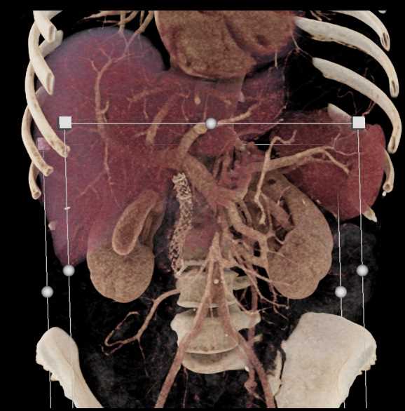 Pancreatic Cancer with Common Bile Duct (CBD) Stent - CTisus CT Scan