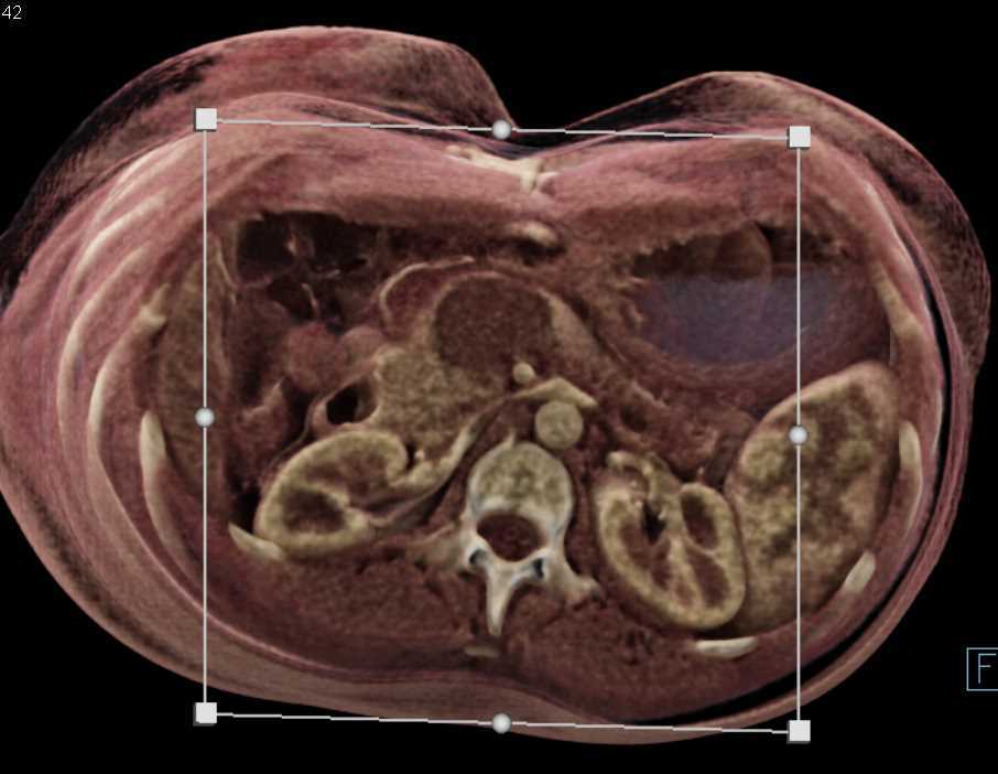 Serous Cystadenoma - CTisus CT Scan