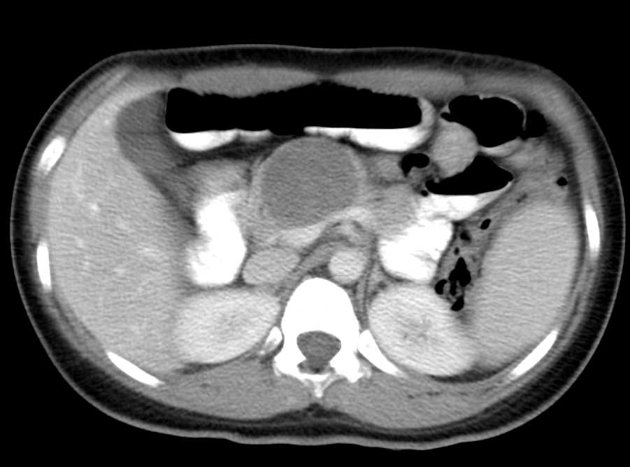 Serous Cystadenoma - CTisus CT Scan
