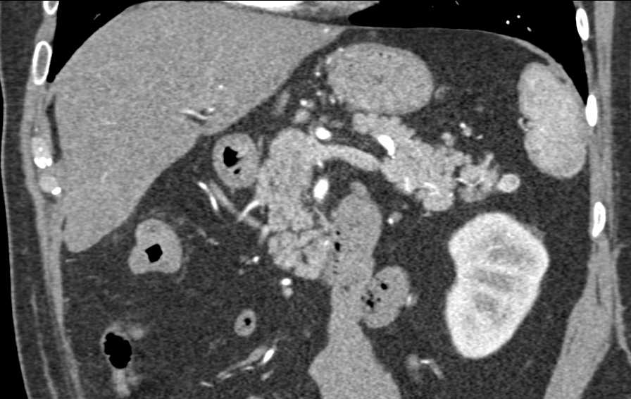 1cm PNET Tail of Pancreas - CTisus CT Scan