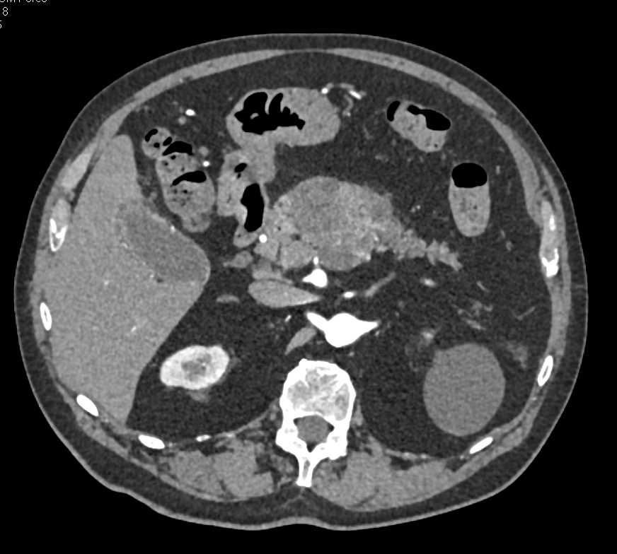 Serous Cystadenoma - CTisus CT Scan