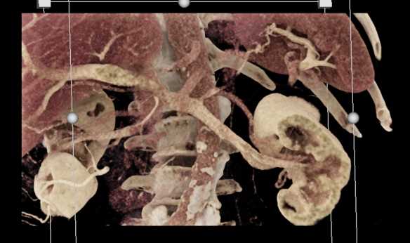 Serous Cystadenoma - CTisus CT Scan