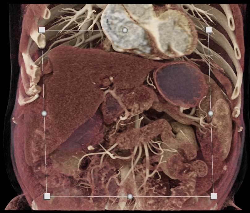 Pancreatic Cancer with Vascular Encasement - CTisus CT Scan