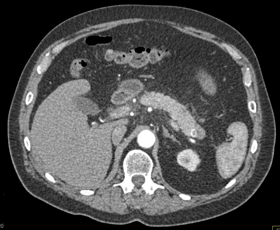 Renal Cell Carcinoma Metastatic to the Pancreas - CTisus CT Scan