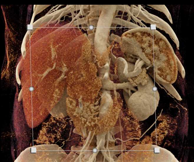 Pancreatic Adenocarcinoma - CTisus CT Scan
