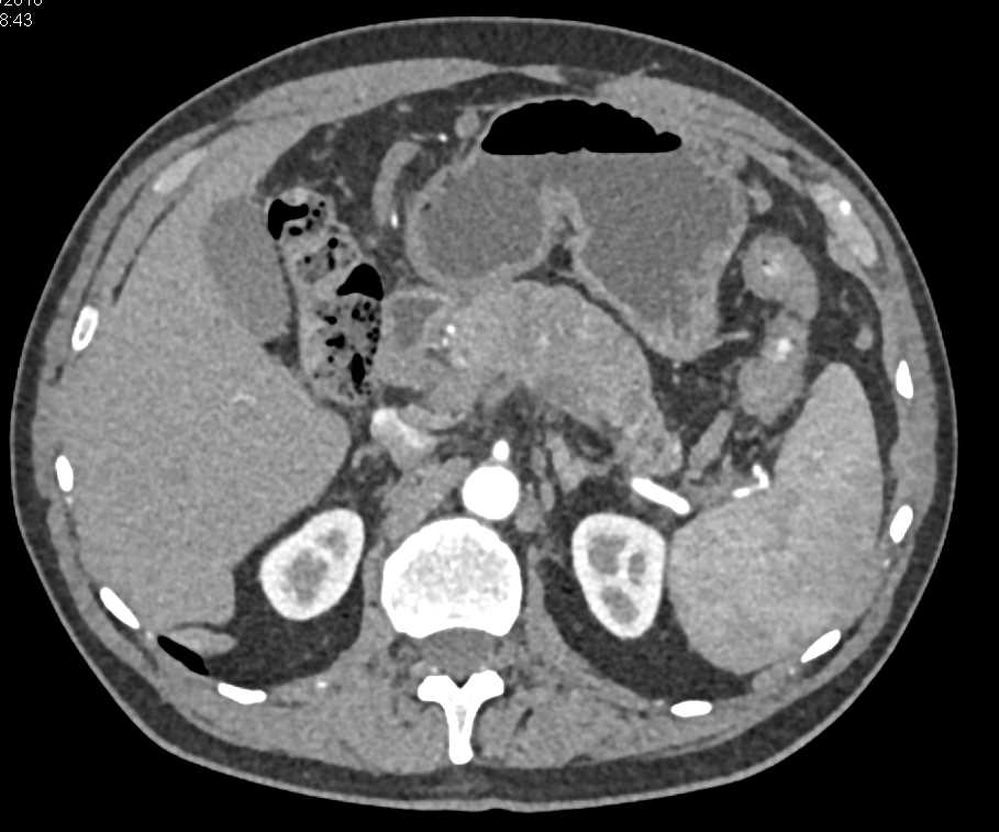 Adenocarcinoma of the Pancreas - CTisus CT Scan