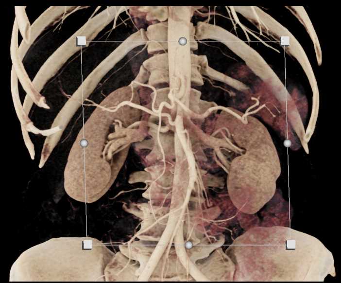 Pancreatic Adenocarcinoma - CTisus CT Scan