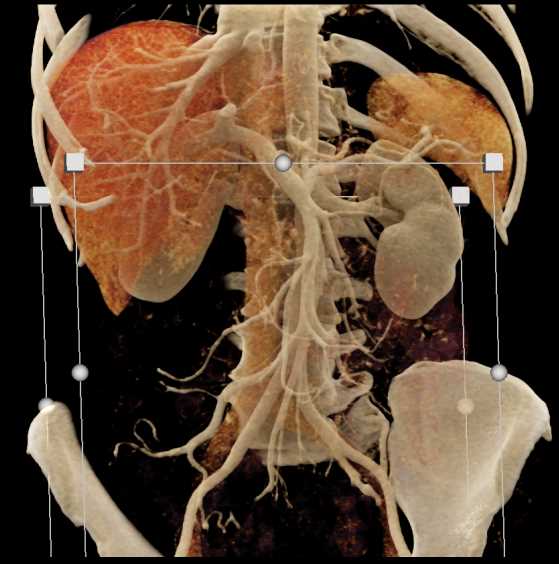 Pancreatic Adenocarcinoma - CTisus CT Scan