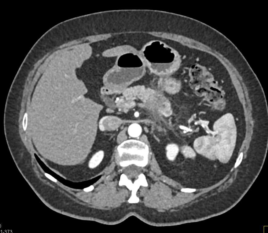 Adenocarcinoma Pancreas - CTisus CT Scan
