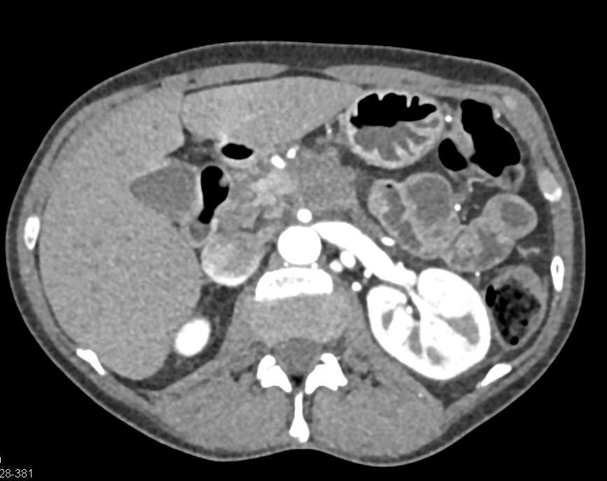 Pancreas Adenocarcinoma - CTisus CT Scan