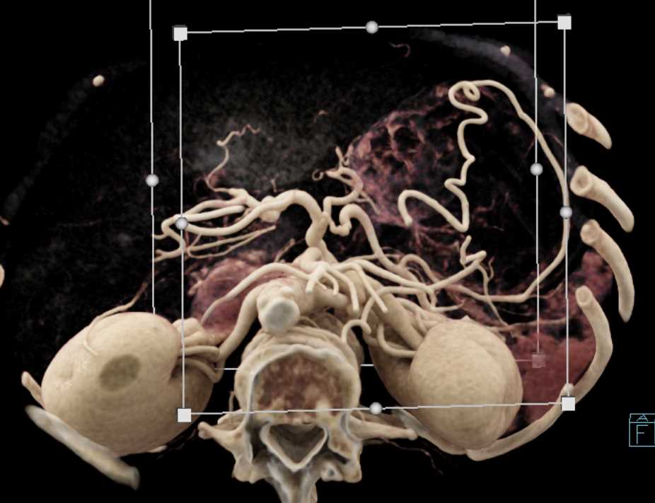 Pancreas Adenocarcinoma with Vessel Invasion - CTisus CT Scan