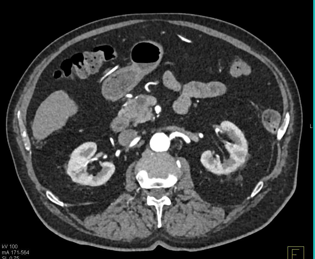 Pancreas Adenocarcinoma with Dilated Pancreatic Duct - CTisus CT Scan