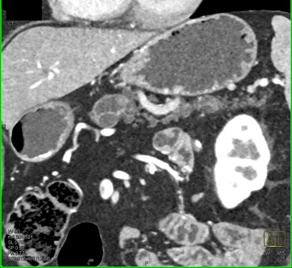 Mixed Type IPMN - CTisus CT Scan