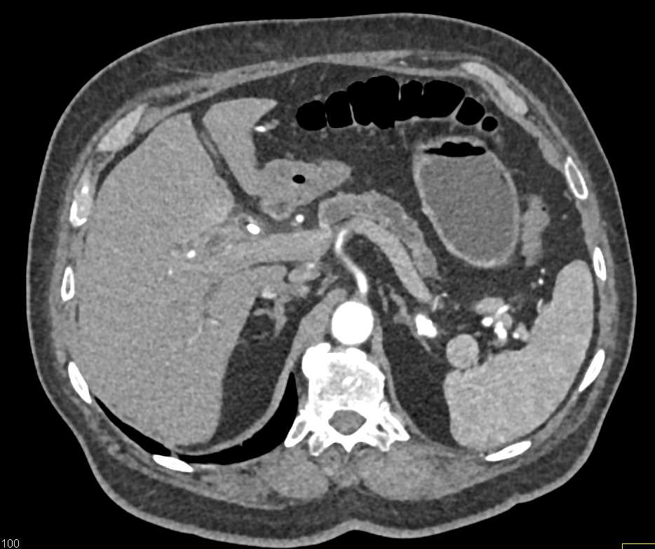 Adenocarcinoma of the Pancreas - CTisus CT Scan