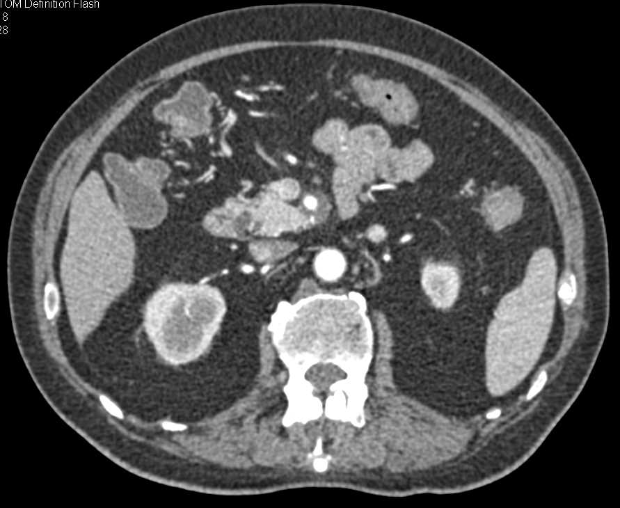 Adenocarcinoma of the Pancreas Encases the Superior Mesenteric Artery (SMA) - CTisus CT Scan