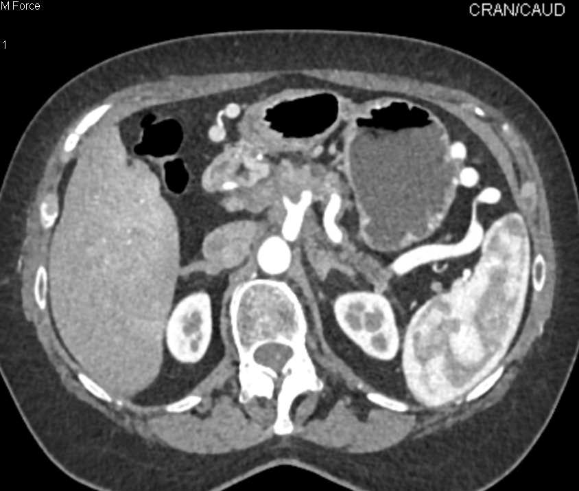 Pancreatic Adenocarcinoma with Vessel Encasement and Omental Implants - CTisus CT Scan
