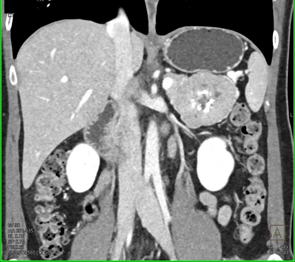 PNET Tail of the Pancreas - CTisus CT Scan
