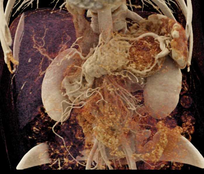 PNET Tail of the Pancreas - CTisus CT Scan