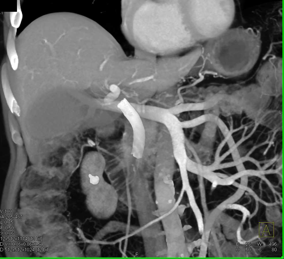 Carcinoma Head of Pancreas - CTisus CT Scan