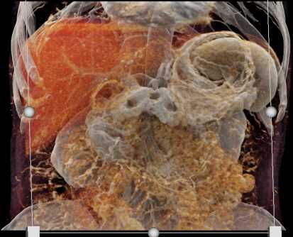 Mixed Type Intraductal Papillary Mucinous Neoplasm (IPMN) - CTisus CT Scan