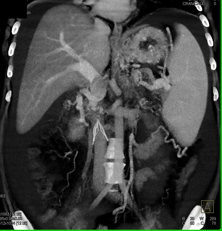 Lymphoma Involves the Pancreas - CTisus CT Scan