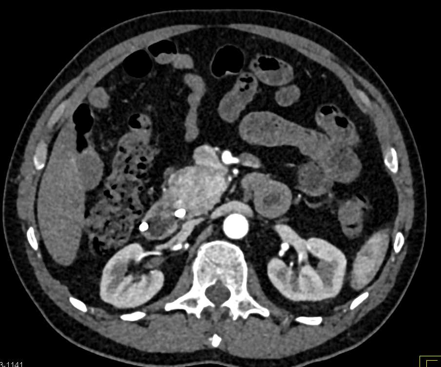 Neuroendocrine Tumor Head of Pancreas - CTisus CT Scan