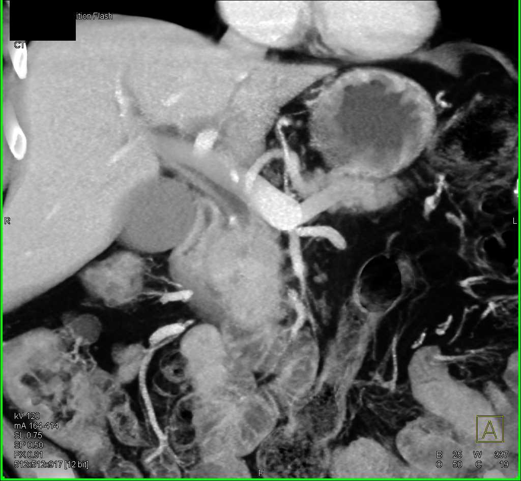 Carcinoma Head of Pancreas - CTisus CT Scan